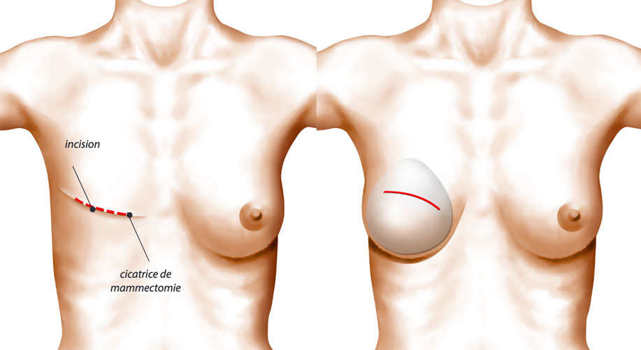 Reconstruction mammaire par prothèses